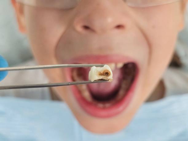 Best Knocked-Out Tooth (Avulsed Tooth) Treatment in Fkville, AL